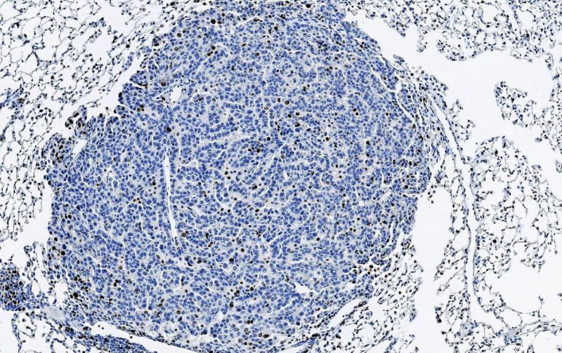La inhibición de la proteína p38 reduce el crecimiento de tumores de pulmón 