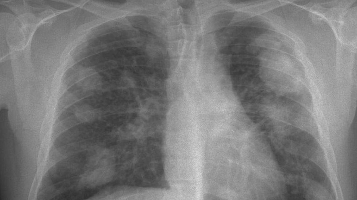 Radiografía de unos pulmones con silicosis complicada